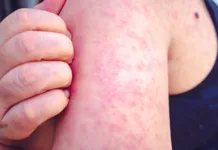 Activaron un protocolo sanitario por un posible caso de sarampión en Nogoyá